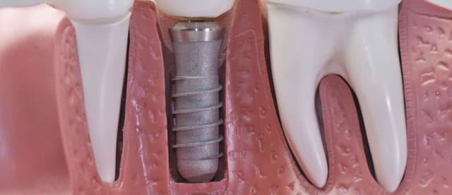 Dental Implants