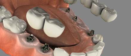Multiple Tooth Dental Implants
