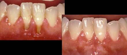 Soft Tissue Grafting